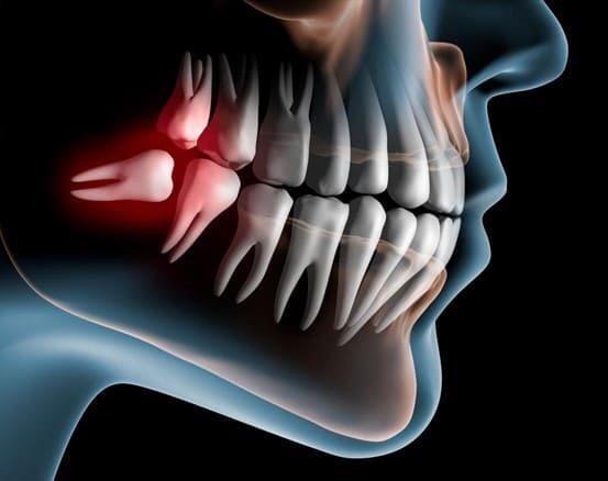 Một trong những nguyên nhân gây đau răng là mọc răng.