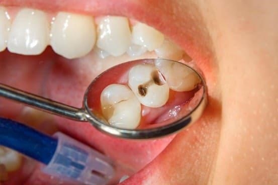 Nguyên nhân phổ biến nhất của đau răng là sâu răng.